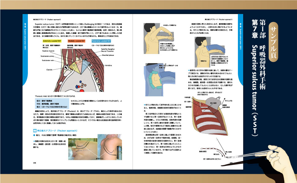 楽天ブックス: イラストで理解する呼吸器外科手術のエッセンス